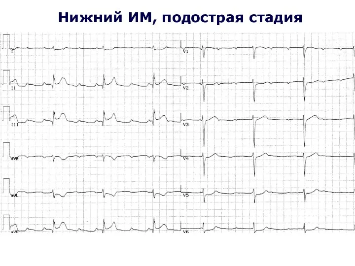 Нижний ИМ, подострая стадия