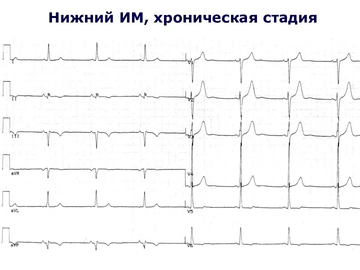 Нижний ИМ, хроническая стадия