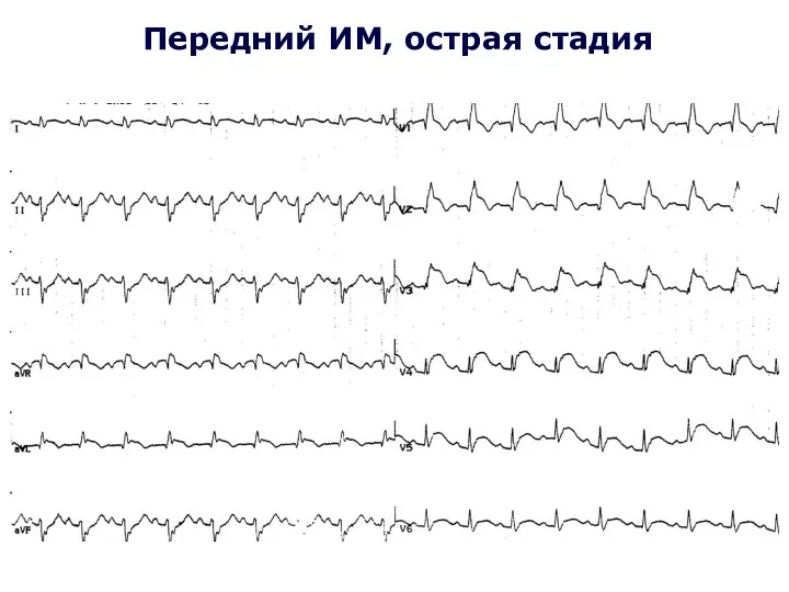 Передний ИМ, острая стадия