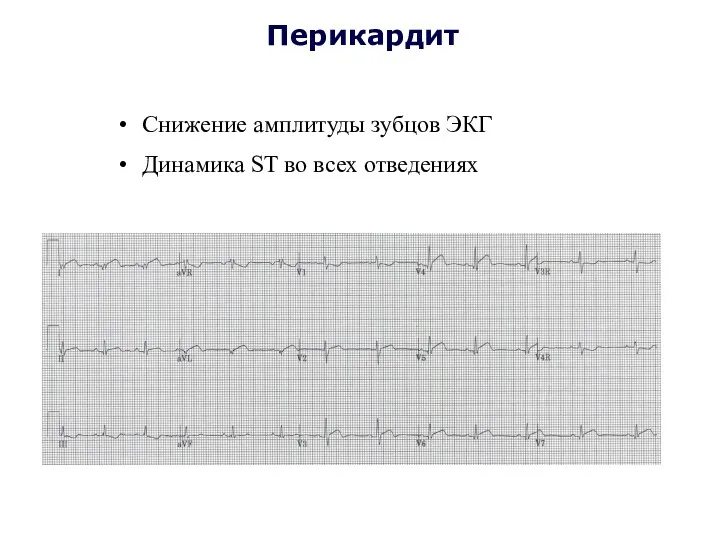 Перикардит Снижение амплитуды зубцов ЭКГ Динамика ST во всех отведениях