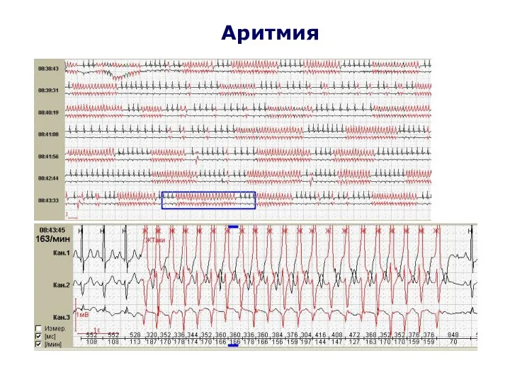 Аритмия