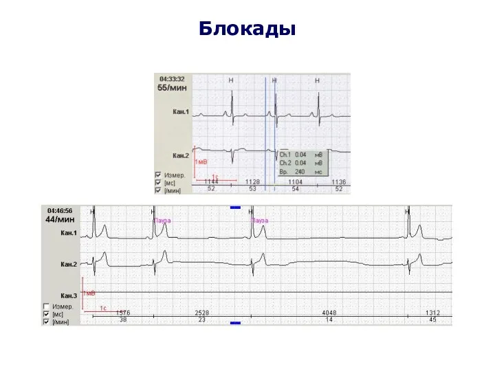 Блокады