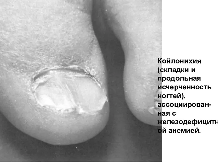Койлонихия (складки и продольная исчерченность ногтей), ассоциирован-ная с железодефицитной анемией.