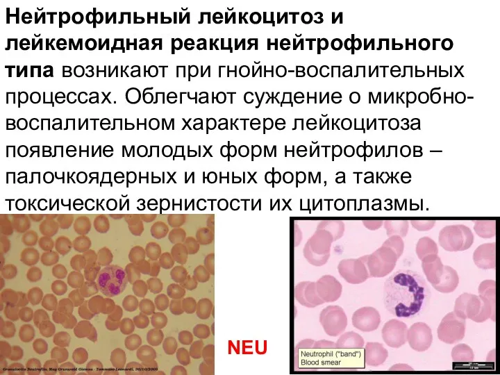 Нейтрофильный лейкоцитоз и лейкемоидная реакция нейтрофильного типа возникают при гнойно-воспалительных