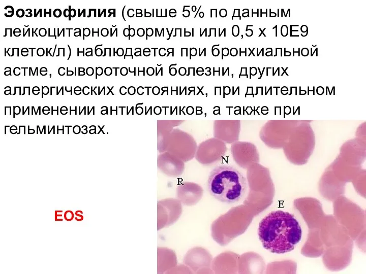 Эозинофилия (свыше 5% по данным лейкоцитарной формулы или 0,5 х
