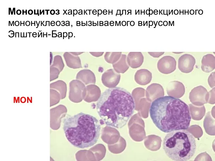 Моноцитоз характерен для инфекционного мононуклеоза, вызываемого вирусом Эпштейн-Барр. MON