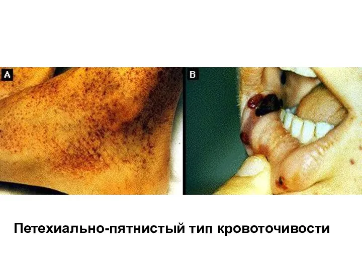 Петехиально-пятнистый тип кровоточивости