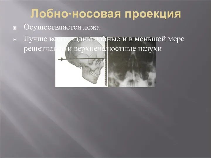 Лобно-носовая проекция Осуществляется лежа Лучше всего видны лобные и в меньшей мере решетчатые и верхнечелюстные пазухи