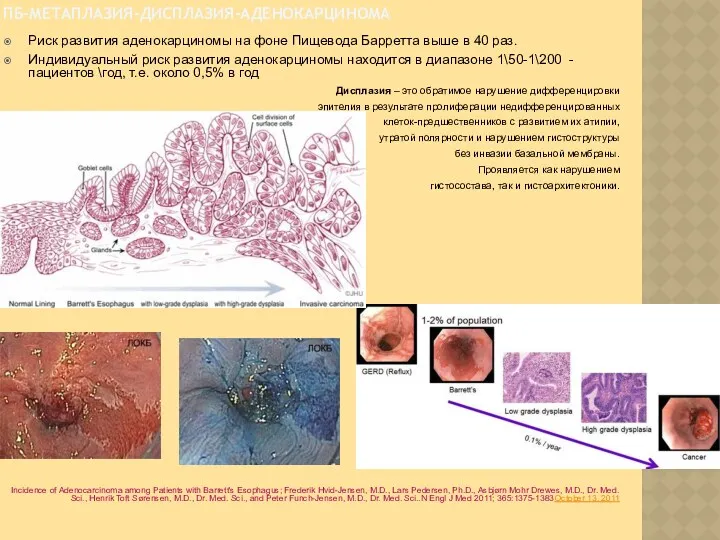 ПБ-МЕТАПЛАЗИЯ-ДИСПЛАЗИЯ-АДЕНОКАРЦИНОМА Риск развития аденокарциномы на фоне Пищевода Барретта выше в 40 раз. Индивидуальный