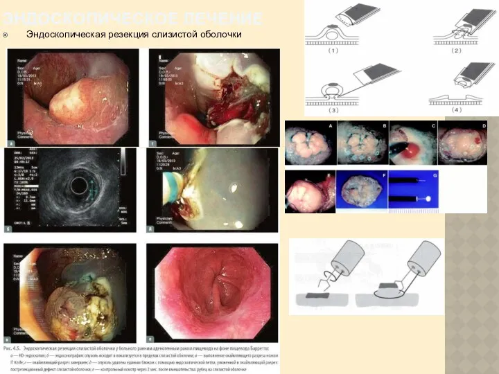 ЭНДОСКОПИЧЕСКОЕ ЛЕЧЕНИЕ Эндоскопическая резекция слизистой оболочки