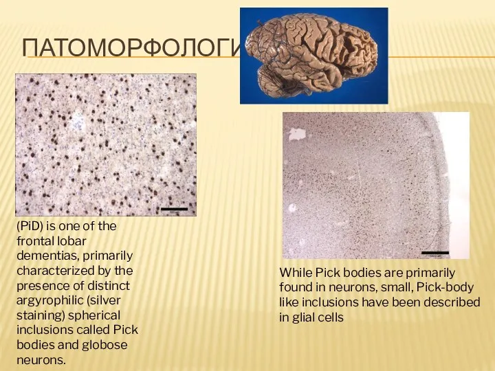 ПАТОМОРФОЛОГИЯ (PiD) is one of the frontal lobar dementias, primarily
