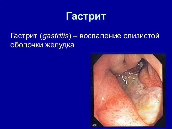 Гастрит Гастрит (gastritis) – воспаление слизистой оболочки желудка