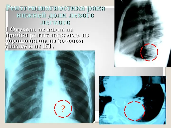 Рентгендиагностика рака нижней доли левого легкого 1.Опухoль не видна на