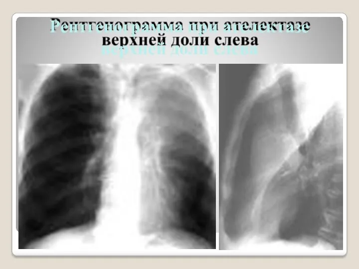 Рентгенограмма при ателектазе верхней доли слева