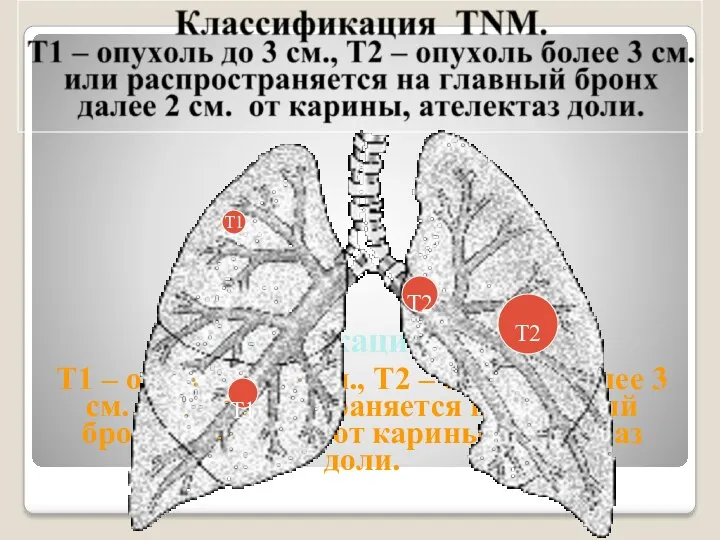 Классификация TNM. Т1 – опухоль до 3 см., Т2 –