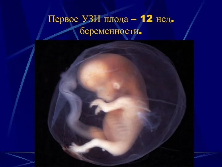 Первое УЗИ плода – 12 нед. беременности.