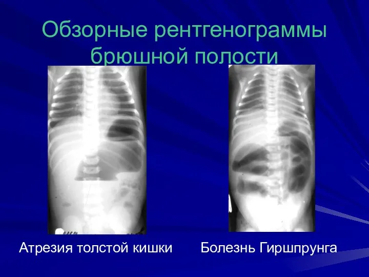 Обзорные рентгенограммы брюшной полости Атрезия толстой кишки Болезнь Гиршпрунга