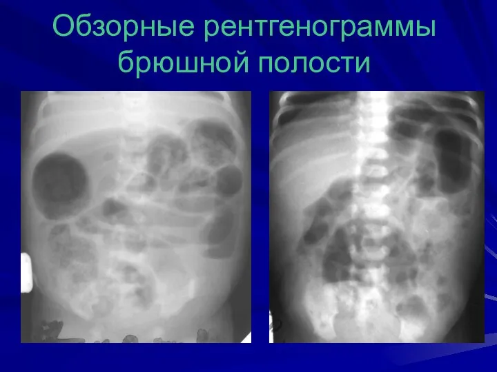 Обзорные рентгенограммы брюшной полости