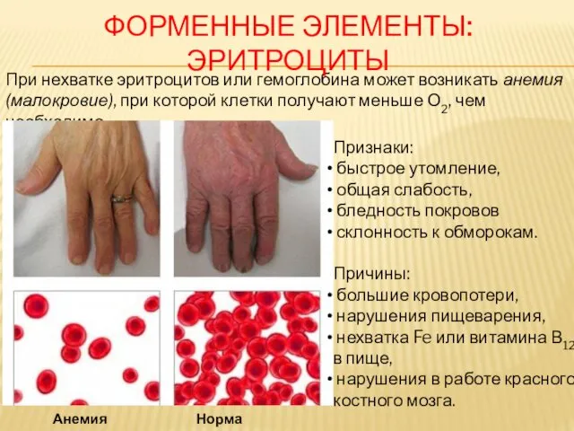 При нехватке эритроцитов или гемоглобина может возникать анемия (малокровие), при