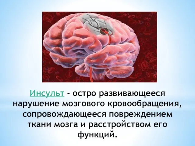 Инсульт - остро развивающееся нарушение мозгового кровообращения, сопровождающееся повреждением ткани мозга и расстройством его функций.
