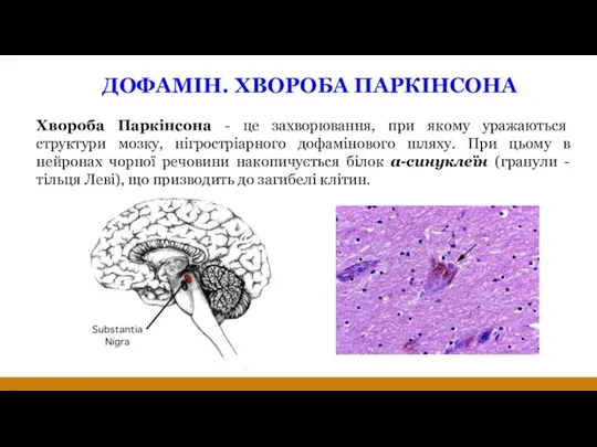 ДОФАМІН. ХВОРОБА ПАРКІНСОНА Хвороба Паркінсона - це захворювання, при якому уражаються структури мозку,