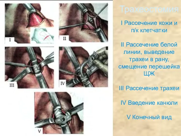 Трахеостомия I Рассечение кожи и п/к клетчатки II Рассечение белой