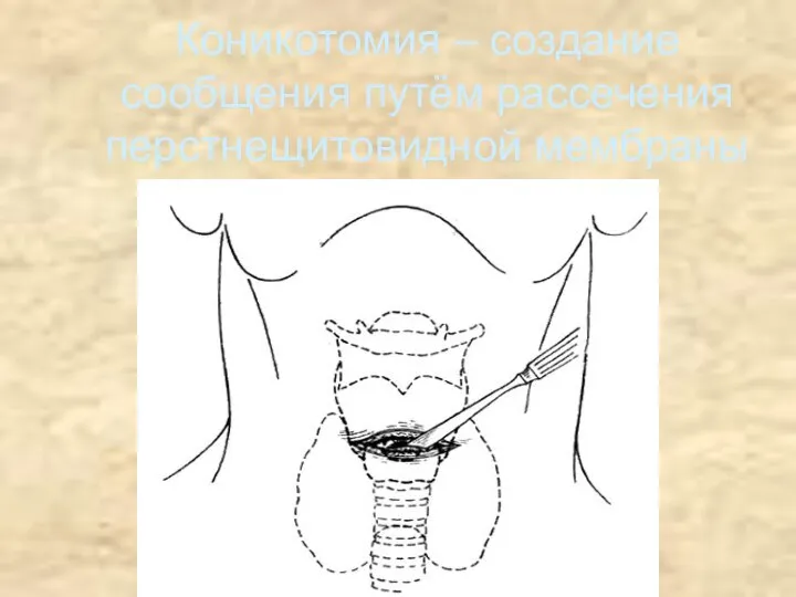 Коникотомия – создание сообщения путём рассечения перстнещитовидной мембраны