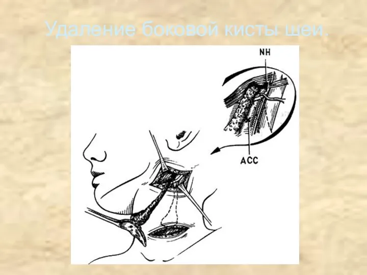 Удаление боковой кисты шеи.