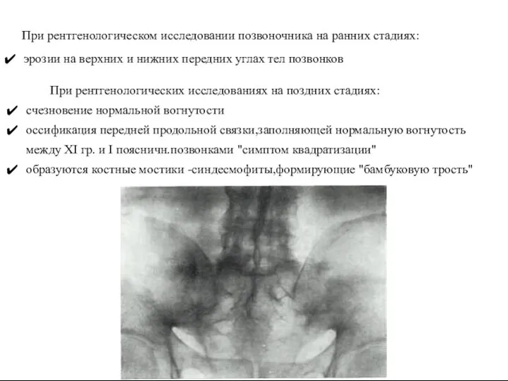 При рентгенологических исследованиях на поздних стадиях: счезновение нормальной вогнутости оссификация передней продольной связки,заполняющей