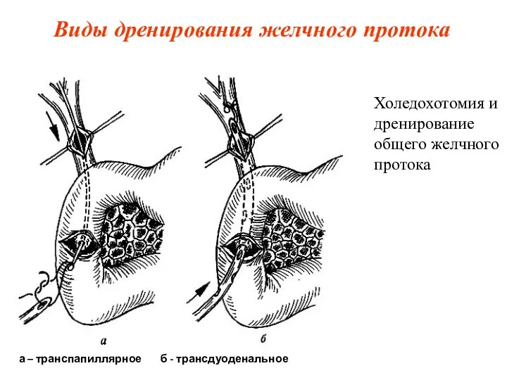 Виды дренирования желчного протока Холедохотомия и дренирование общего желчного протока а – транспапиллярное б - трансдуоденальное