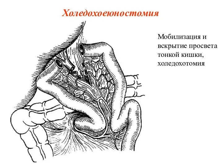 Холедохоеюностомия Мобилизация и вскрытие просвета тонкой кишки, холедохотомия