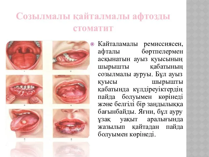 Созылмалы қайталмалы афтозды стоматит Кайталамалы ремиссиясен, афталы бөртпелермен асқынатын ауыз