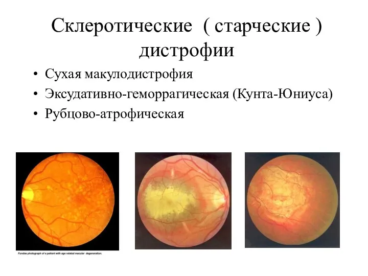 Склеротические ( старческие ) дистрофии Сухая макулодистрофия Эксудативно-геморрагическая (Кунта-Юниуса) Рубцово-атрофическая