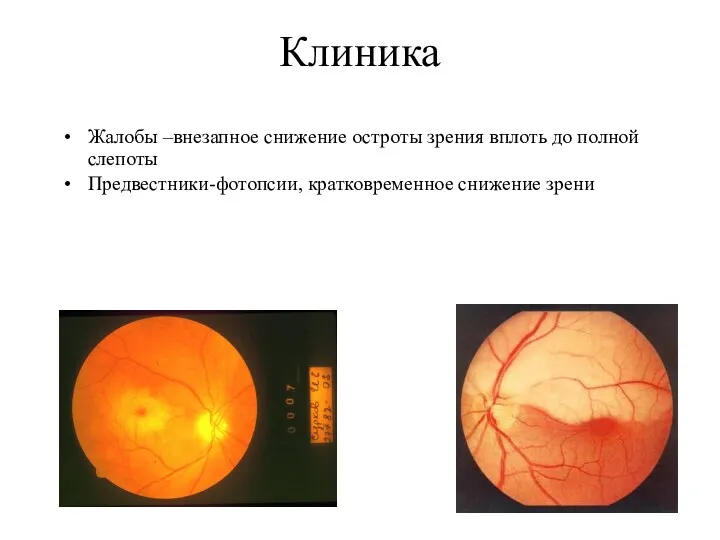 Клиника Жалобы –внезапное снижение остроты зрения вплоть до полной слепоты Предвестники-фотопсии, кратковременное снижение зрени