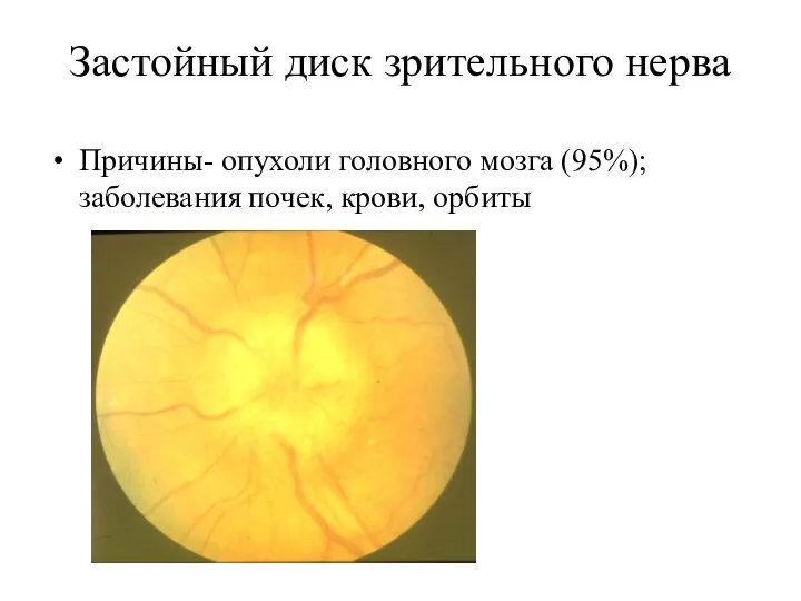 Застойный диск зрительного нерва Причины- опухоли головного мозга (95%); заболевания почек, крови, орбиты