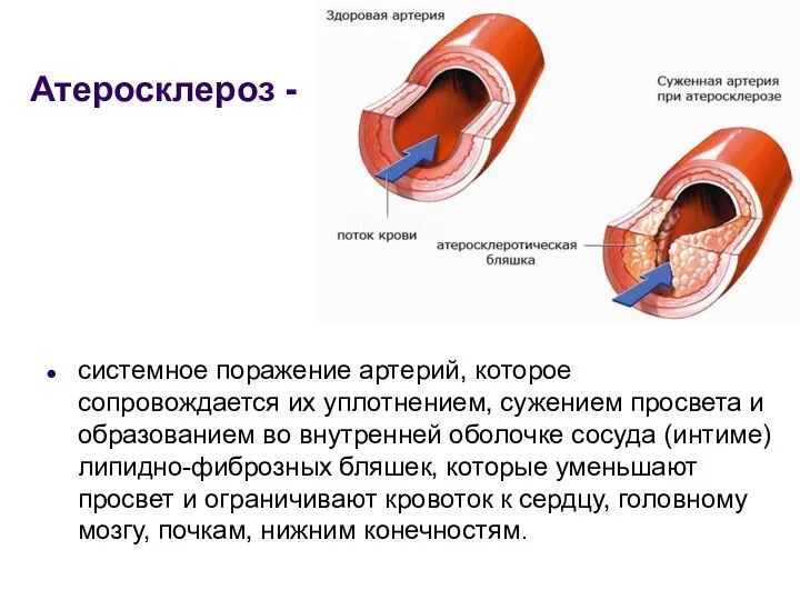 Атеросклероз - системное поражение артерий, которое сопровождается их уплотнением, сужением