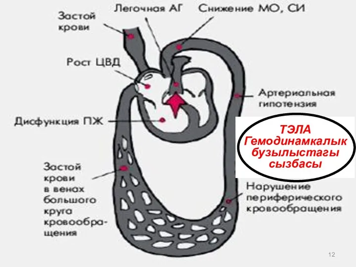 ТЭЛА Гемодинамкалык бузылыстагы сызбасы