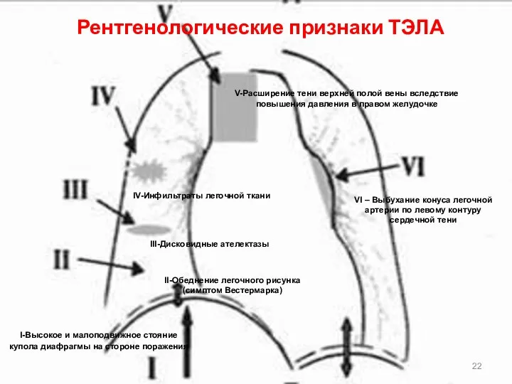 Рентгенологические признаки ТЭЛА VI – Выбухание конуса легочной артерии по