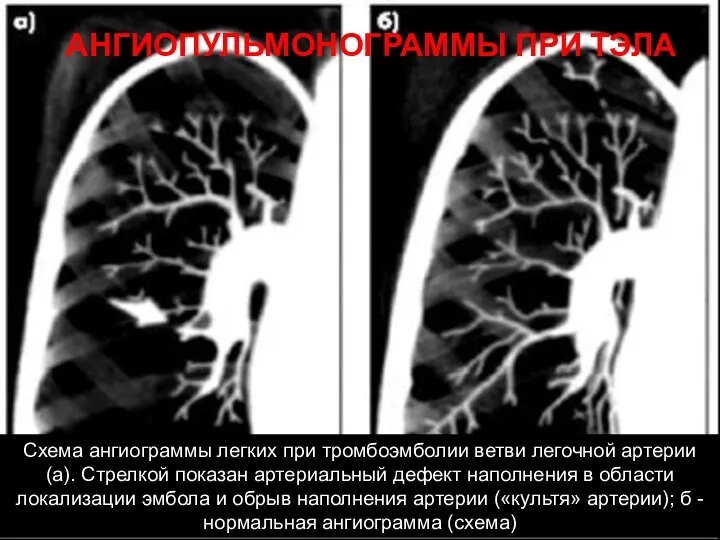 АНГИОПУЛЬМОНОГРАММЫ ПРИ ТЭЛА Схема ангиограммы легких при тромбоэмболии ветви легочной