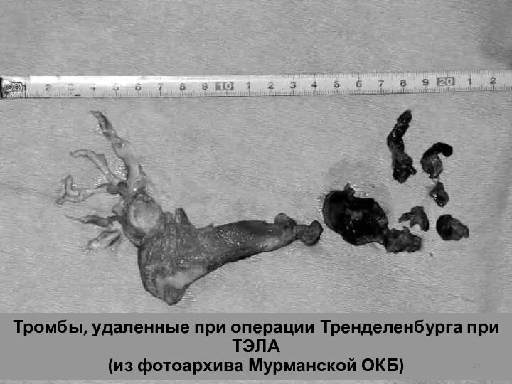 Тромбы, удаленные при операции Тренделенбурга при ТЭЛА (из фотоархива Мурманской ОКБ)