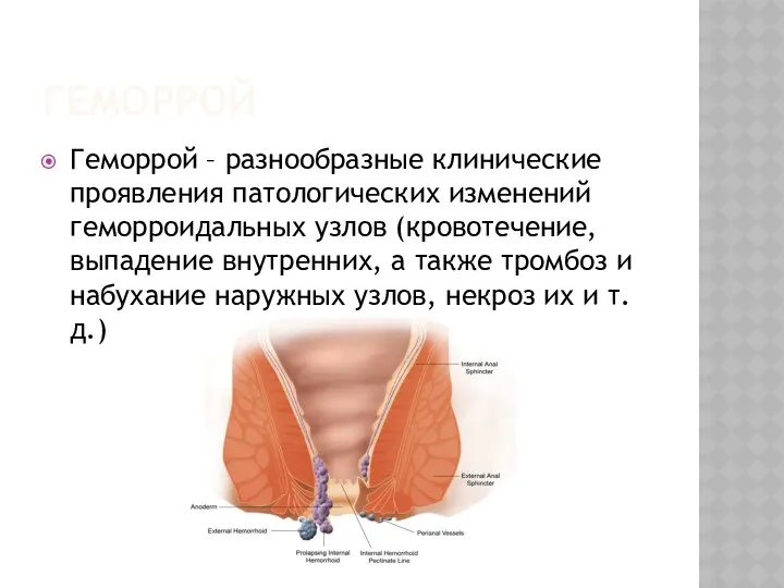 ГЕМОРРОЙ Геморрой – разнообразные клинические проявления патологических изменений геморроидальных узлов