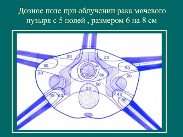 Дозное поле при облучении рака мочевого пузыря с 5 полей , размером 6 на 8 см