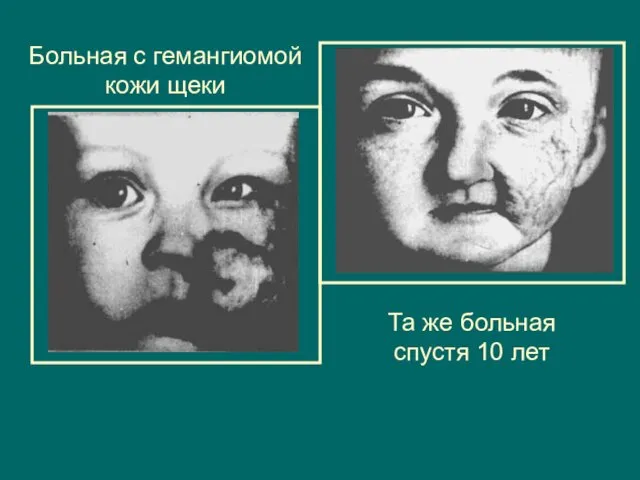 Больная с гемангиомой кожи щеки Та же больная спустя 10 лет