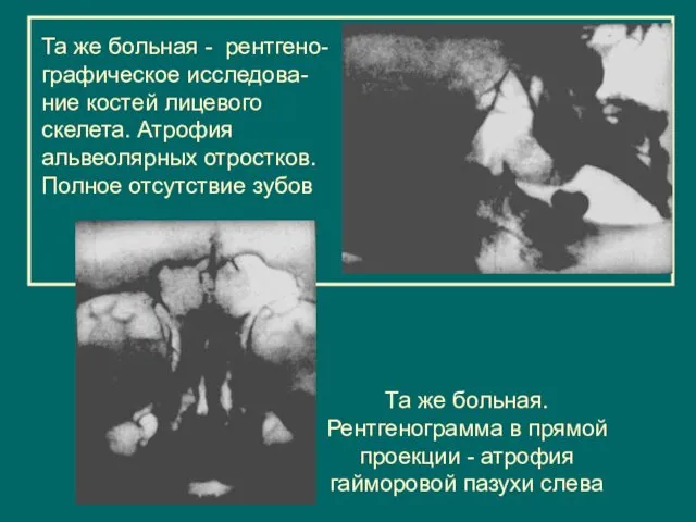 Та же больная - рентгено- графическое исследова-ние костей лицевого скелета.