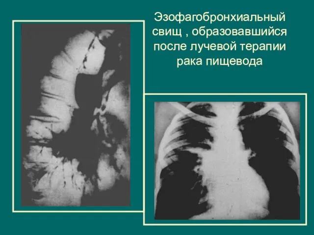 Эзофагобронхиальный свищ , образовавшийся после лучевой терапии рака пищевода