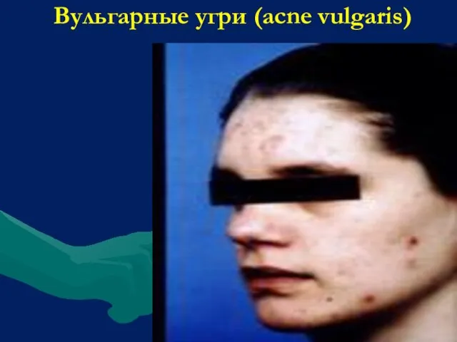 Вульгарные угри (acne vulgaris)