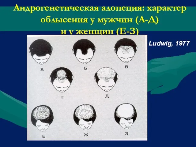 Андрогенетическая алопеция: характер облысения у мужчин (А-Д) и у женщин (Е-З) Ludwig, 1977