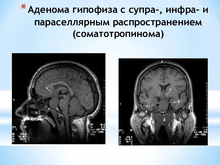 Аденома гипофиза с супра-, инфра- и параселлярным распространением (соматотропинома)