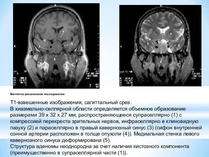 Магнитно-резонансное исследование Т1-взвешенные изображения, сагиттальный срез. В хиазмально-селлярной области определяется объемное образование размерами