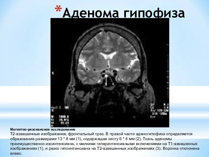 Аденома гипофиза Магнитно-резонансное исследование Т2-взвешенные изображения, фронтальный срез. В правой